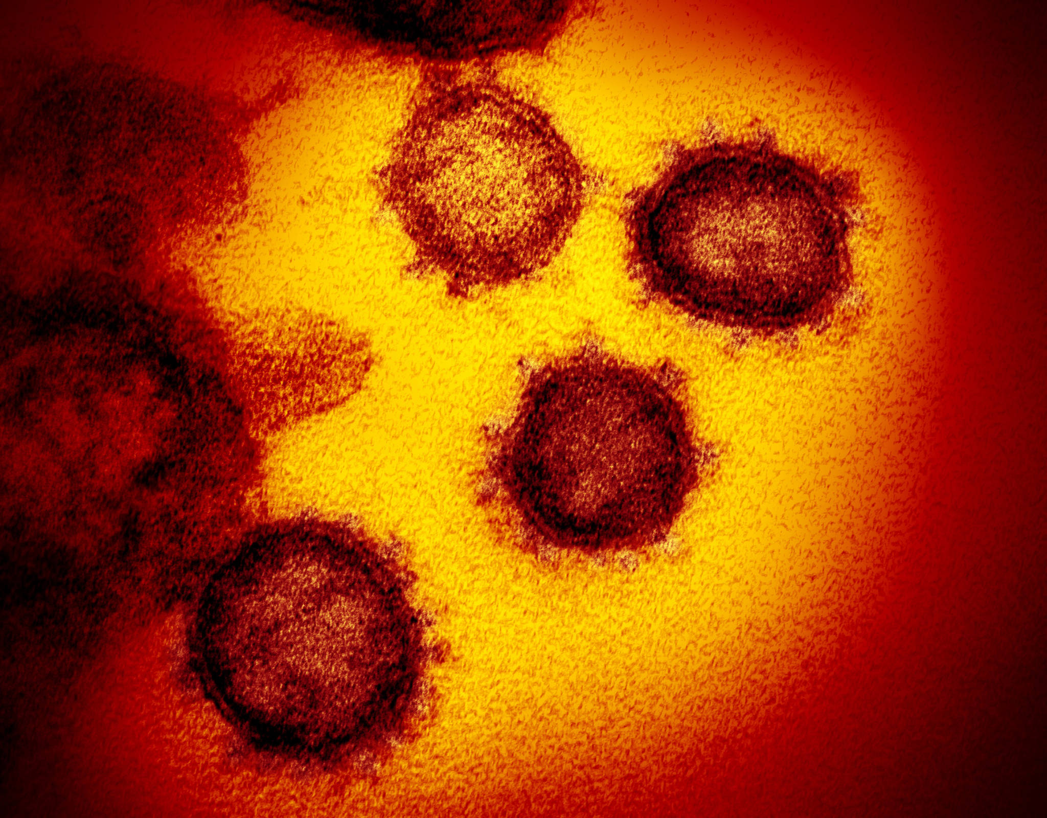 This undated electron microscope image made available by the U.S. National Institutes of Health in February 2020 shows the Novel Coronavirus SARS-CoV-2. Also known as 2019-nCoV, the virus causes COVID-19. The sample was isolated from a patient in the U.S. (Courtesy Photo | NIAID-RML via AP)