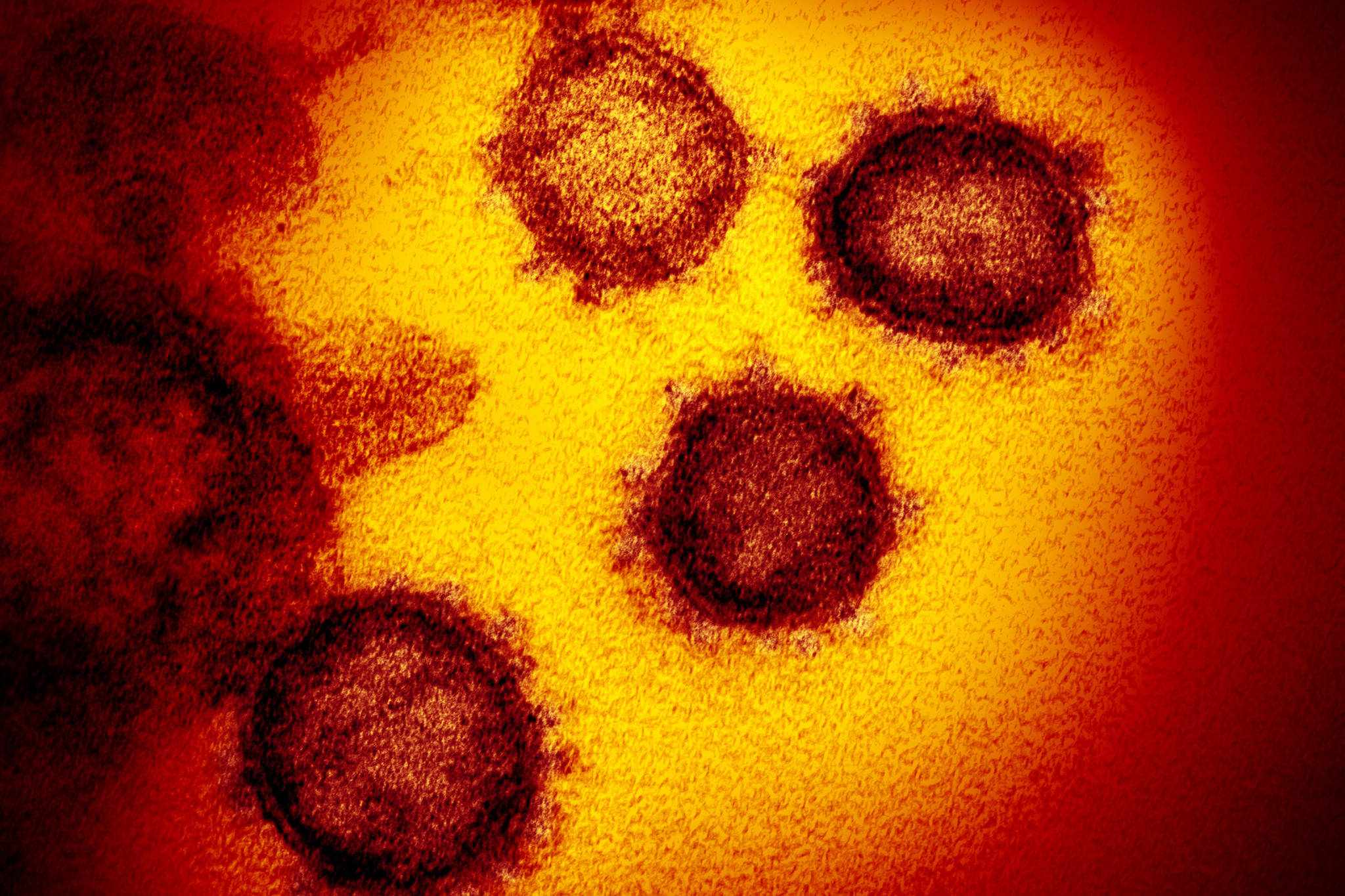 This undated electron microscope image made available by the U.S. National Institutes of Health in February 2020 shows the Novel Coronavirus SARS-CoV-2. Also known as 2019-nCoV, the virus causes COVID-19. The sample was isolated from a patient in the U.S. (Courtesy Photo | NIAID-RML via AP)