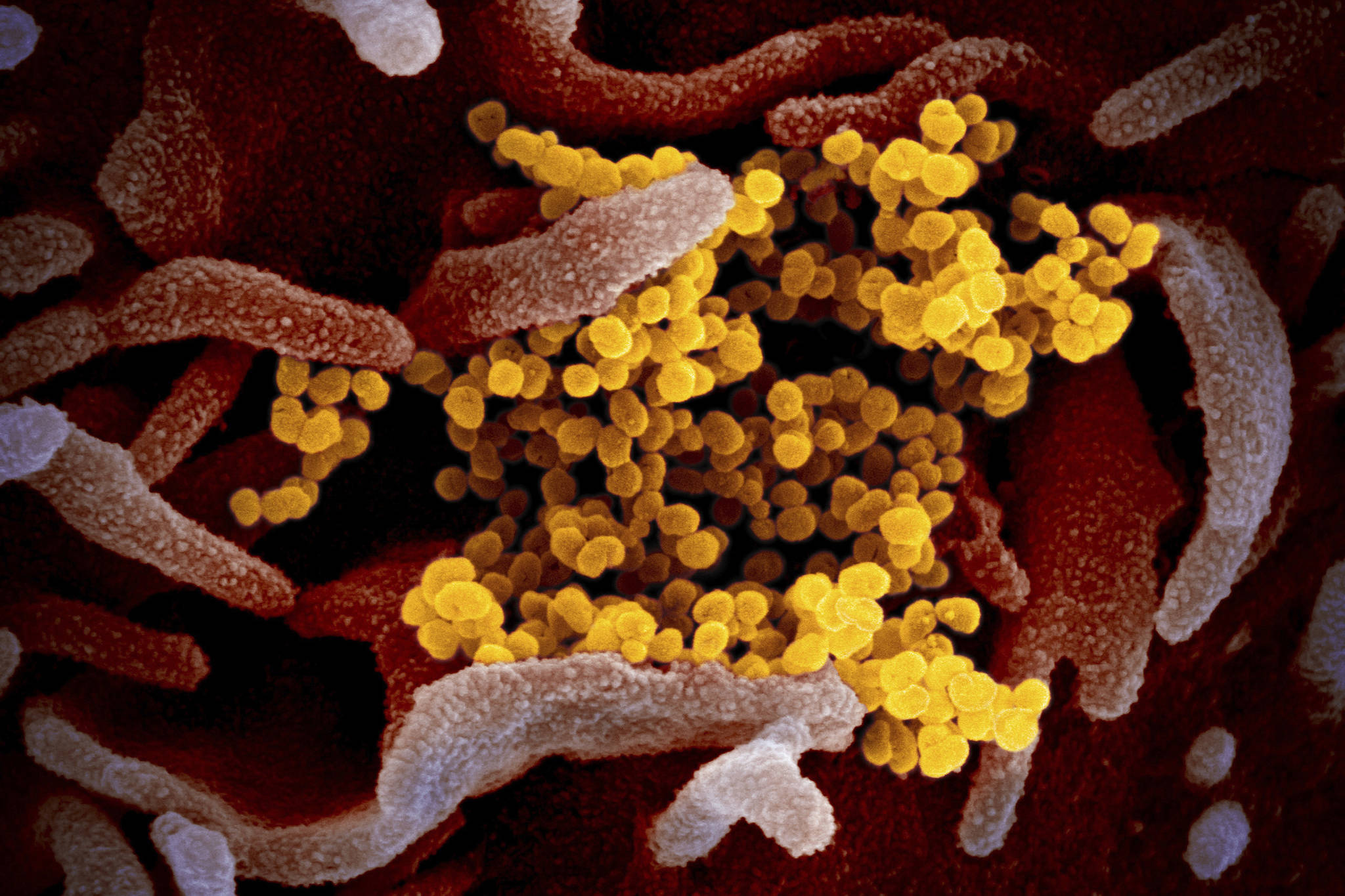 This undated electron microscope image made available by the U.S. National Institutes of Health in February 2020 shows the Novel Coronavirus SARS-CoV-2, yellow, emerging from the surface of cells, pink, cultured in the lab. (NIAID-RML via AP)