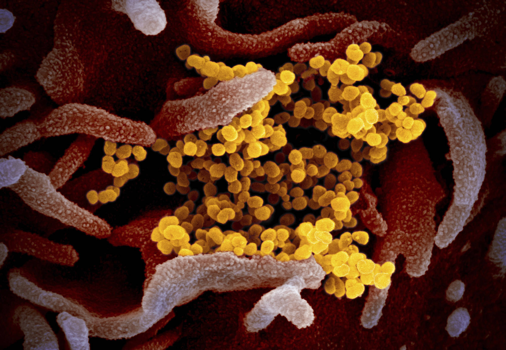 This undated electron microscope image made available by the U.S. National Institutes of Health in February 2020 shows the Novel Coronavirus SARS-CoV-2, orange, emerging from the surface of cells, gray, cultured in the lab. Also known as 2019-nCoV, the virus causes COVID-19. Experts say researchers racing against time to provide a proven treatment for COVID-19 will have to balance scientific rigor against speed. THE CANADIAN PRESS/NIAID-RML via AP