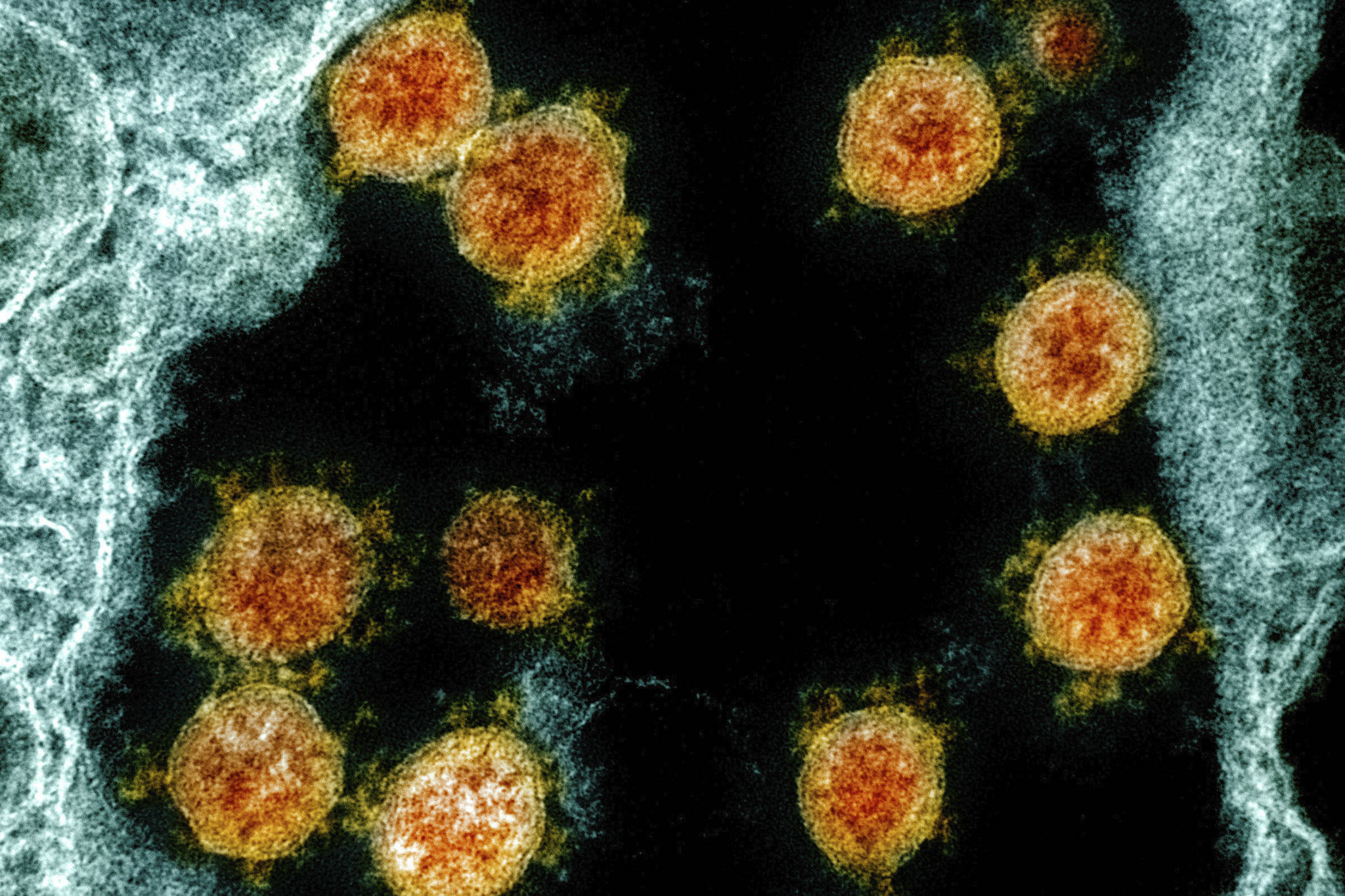 This electron microscope image made available and color-enhanced by the National Institute of Allergy and Infectious Diseases Integrated Research Facility in Fort Detrick, Md., shows Novel Coronavirus SARS-CoV-2 virus particles, orange, isolated from a patient. (Courtesy Image | NIAID, National Institutes of Health)