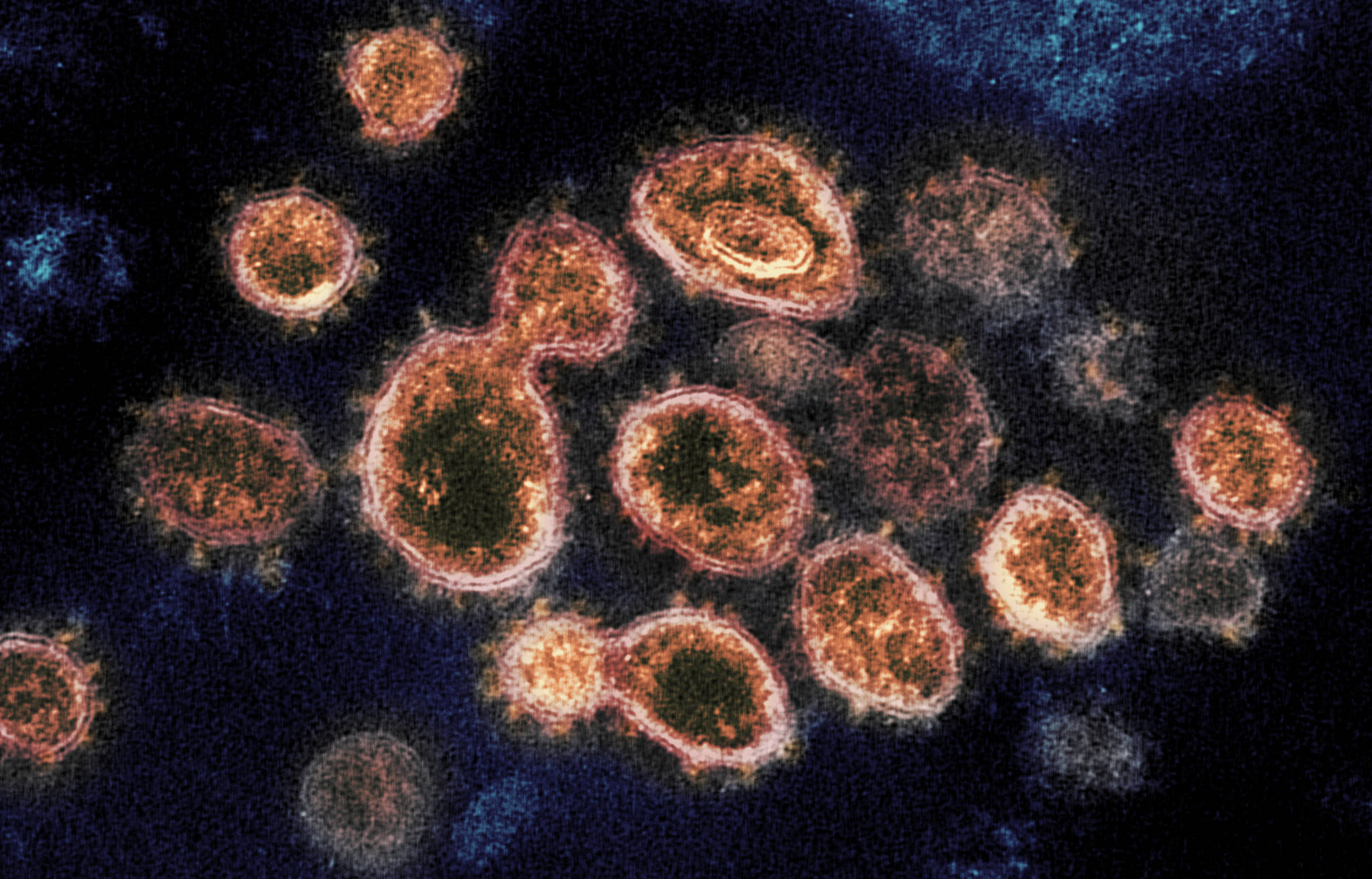 This 2020 electron microscope image provided by the National Institute of Allergy and Infectious Diseases - Rocky Mountain Laboratories shows SARS-CoV-2 virus particles which causes COVID-19, isolated from a patient in the U.S., emerging from the surface of cells cultured in a lab. (NIAID-RML via AP)