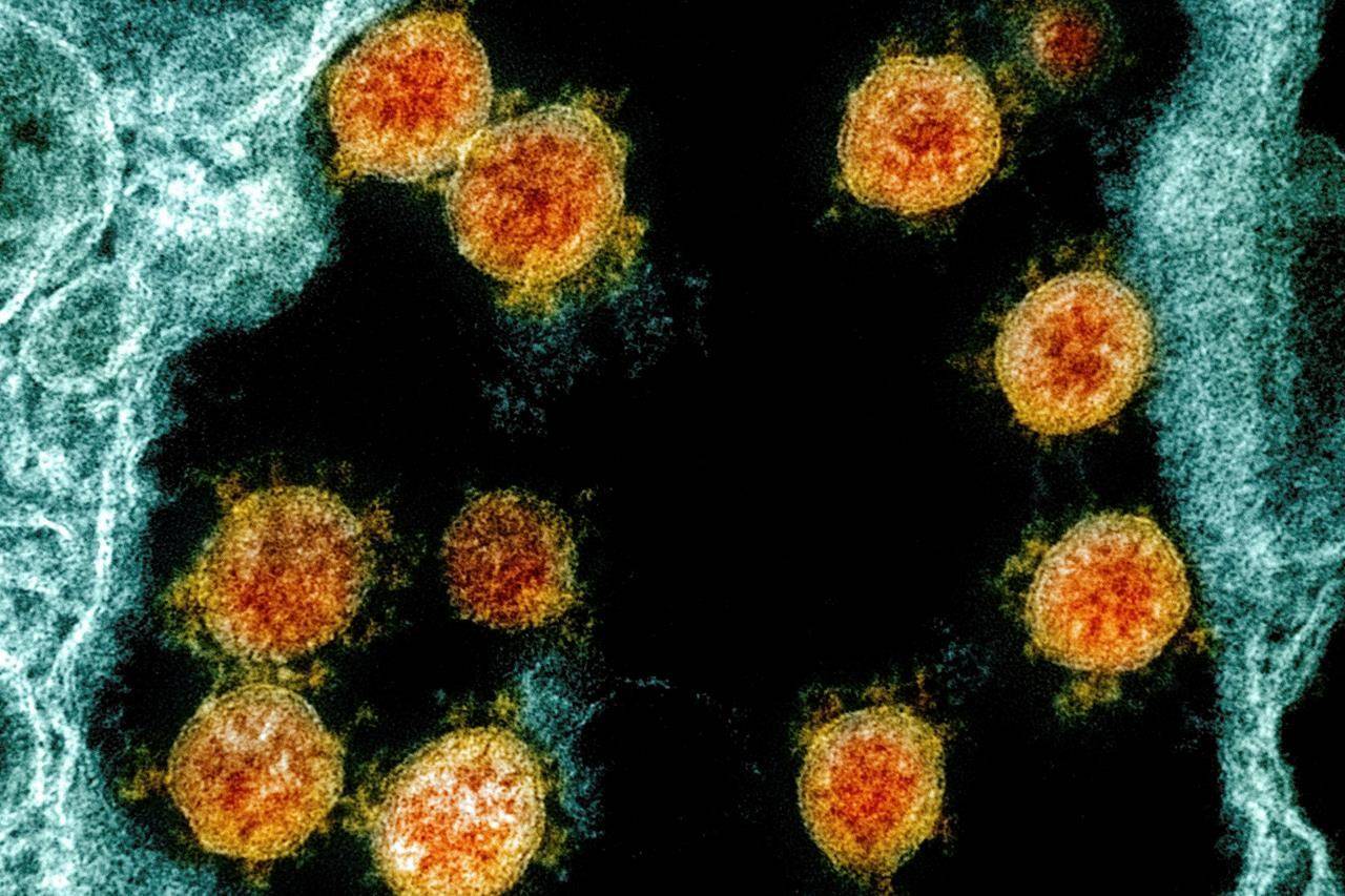 NIAID / National Institutes of Health via AP                                This image shows Novel Coronavirus SARS-CoV-2 virus particles, orange, isolated from a patient.