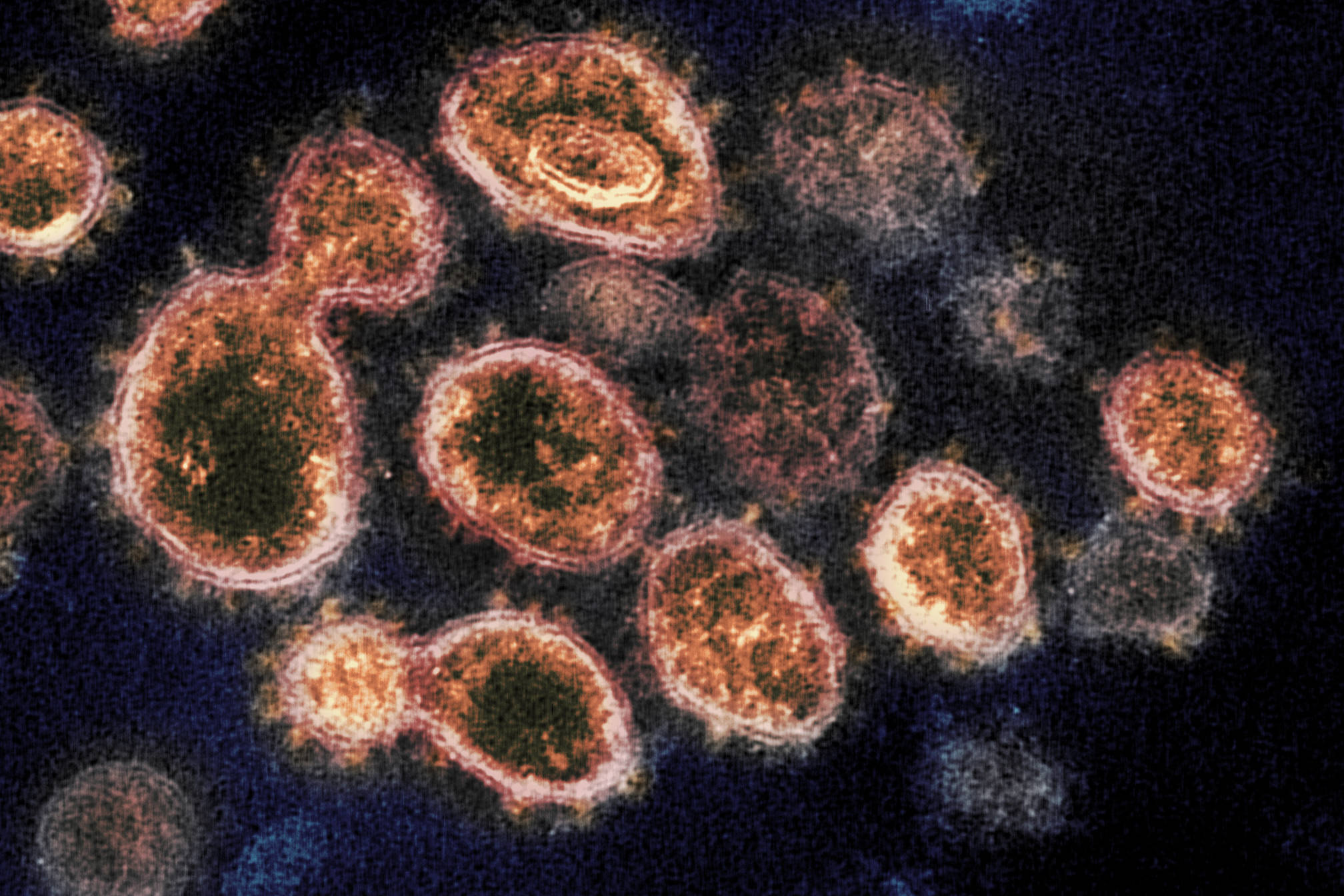 This 2020 electron microscope image provided by the National Institute of Allergy and Infectious Diseases - Rocky Mountain Laboratories shows SARS-CoV-2 virus particles which causes COVID-19, isolated from a patient in the U.S., emerging from the surface of cells cultured in a lab. On Monday, Oct. 5, 2020, the top U.S. public health agency said that coronavirus can spread greater distances through the air than 6 feet, particularly in poorly ventilated and enclosed spaces. But agency officials continued to say such spread is uncommon, and current social distancing guidelines still make sense. (NIAID-RML via AP)