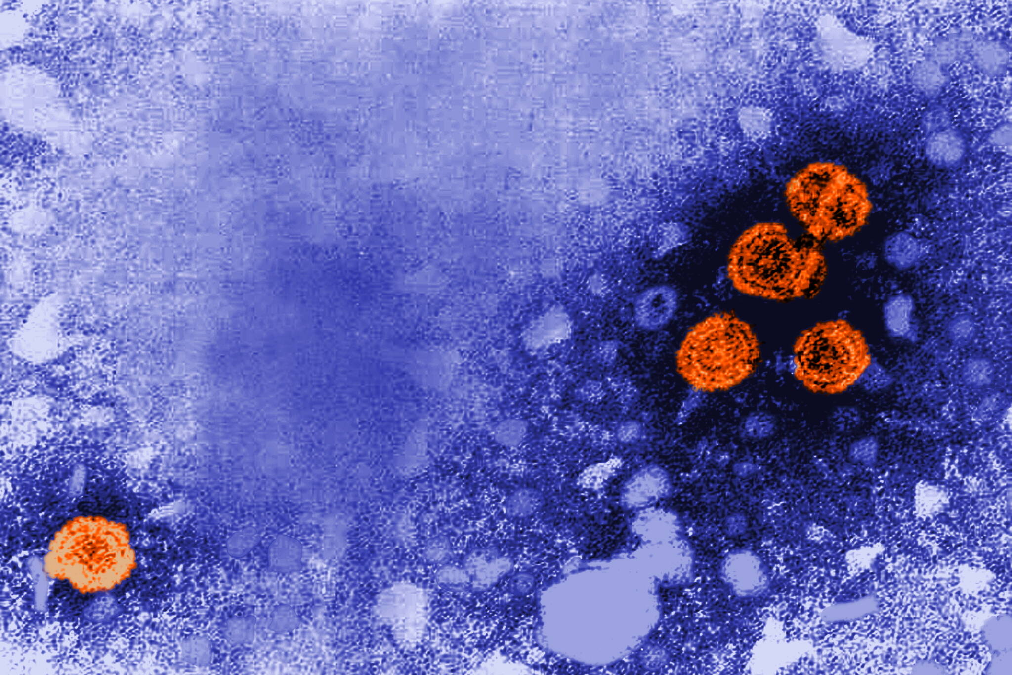 Hepatitis B virus particles, in orange, are seen in this microscopic image captured in 1981. Since so many people are unaware that they are infected, state health officials recommend stepped-up screening. (Photo by Dr. Erskin Palmer/U.S. Centers for Disease Control and Prevention)