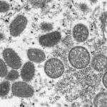 This 2003 electron microscope image made available by the Centers for Disease Control and Prevention shows mature, oval-shaped monkeypox virions, left, and spherical immature virions, right, obtained from a sample of human skin associated with the 2003 prairie dog outbreak. The spread of monkeypox in the U.S. in 2022 could represent the dawn of a new sexually transmitted disease, or it could yet be contained. Or it might be too early to tell. (Cynthia S. Goldsmith, Russell Regner/CDC via AP, File)